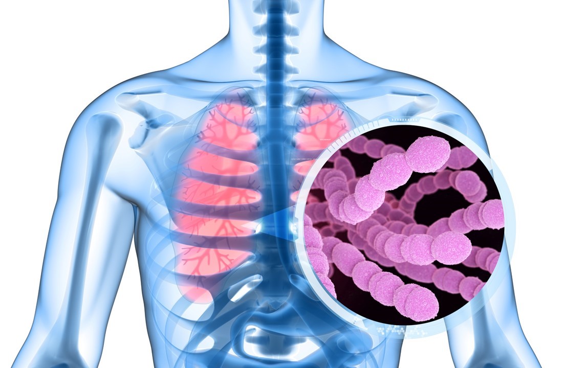 什麼是肺炎鏈球菌？孩童該如何預防？施打疫苗有機會降低COVID-19感染率？帶您完整了解常見症狀與疫苗